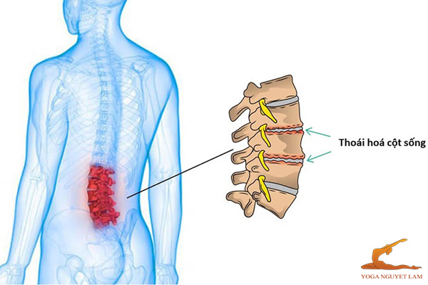 Lợi ích của các bài tập thoái hóa cột sống lưng